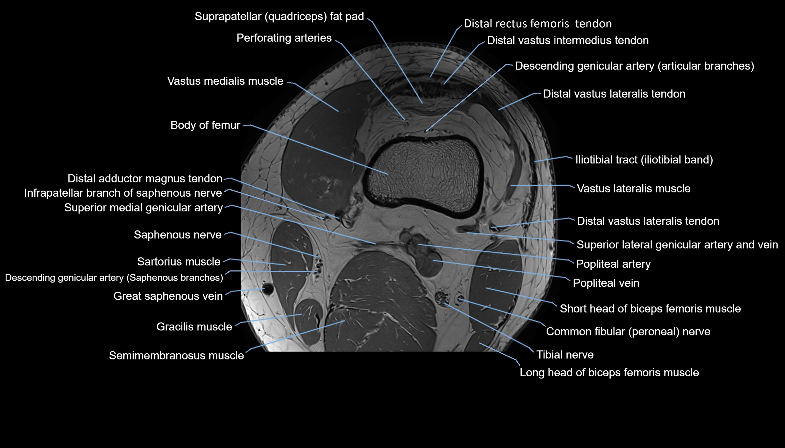 MRI knee  axial cross sectional anatomy 3T radiology  image-img-00001-00005.webp